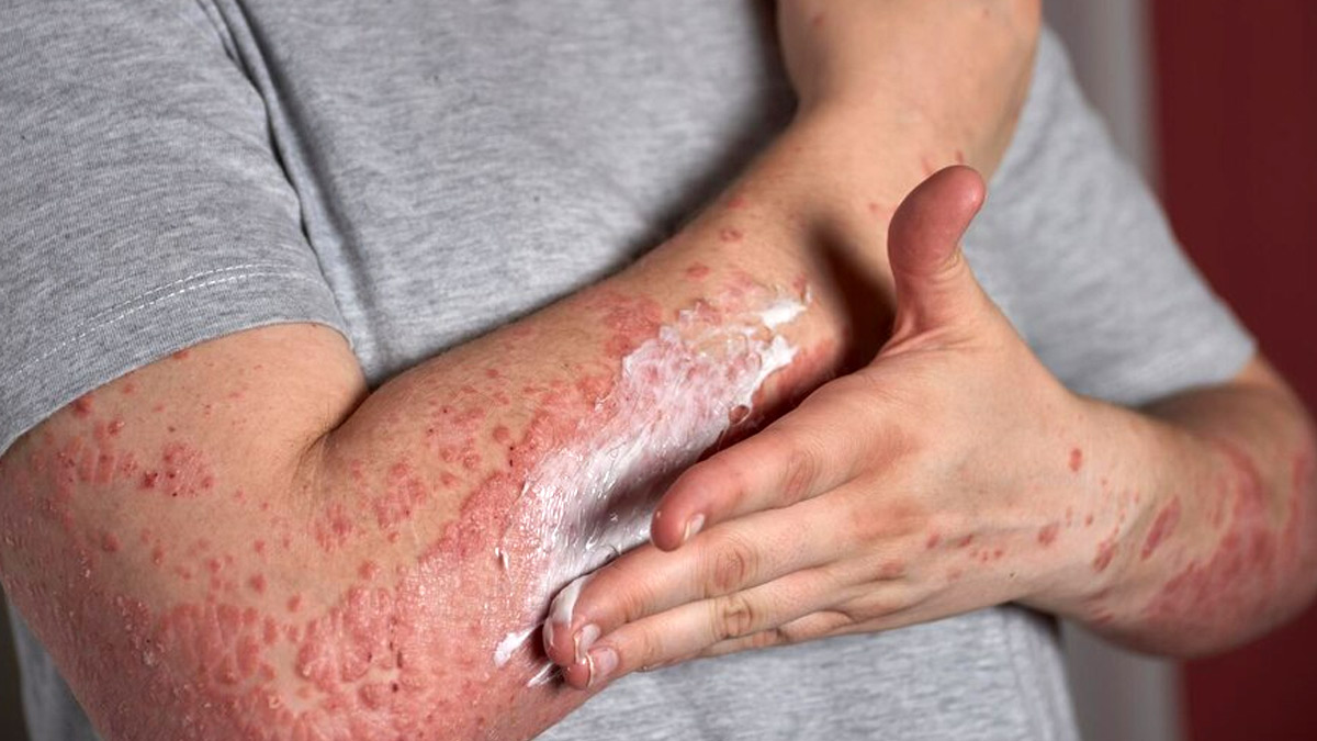 psoriasis-treatment
