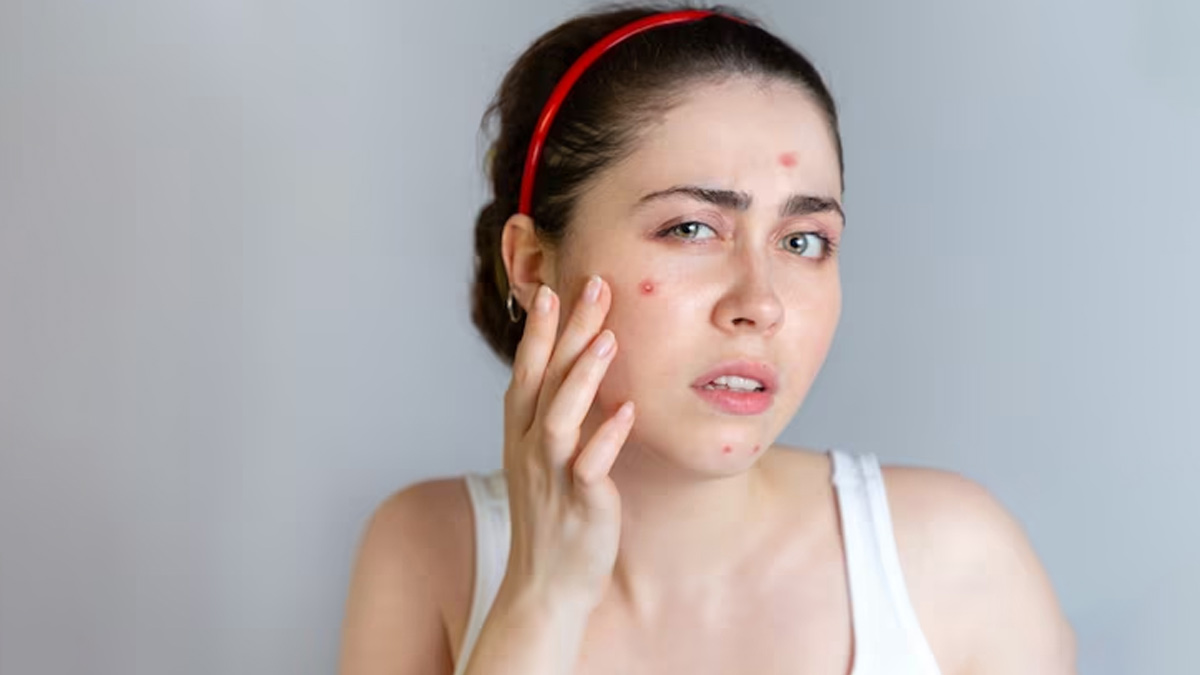 bacterial acne vs hormonal acne