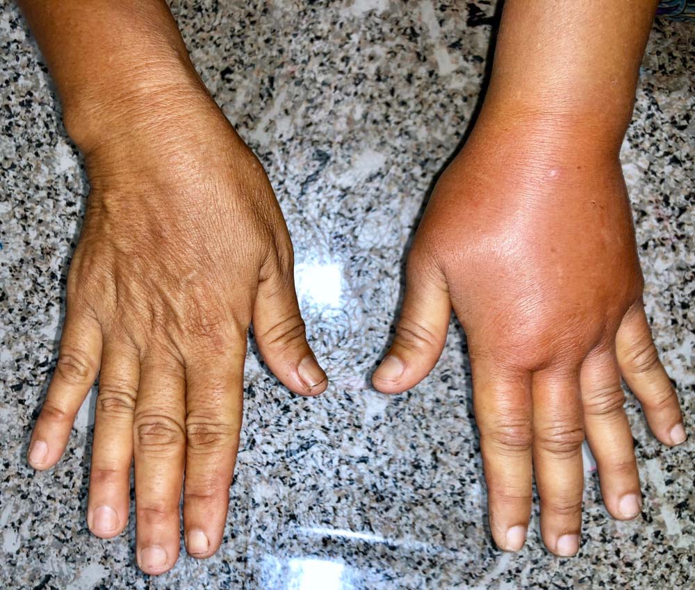 Lymphedema