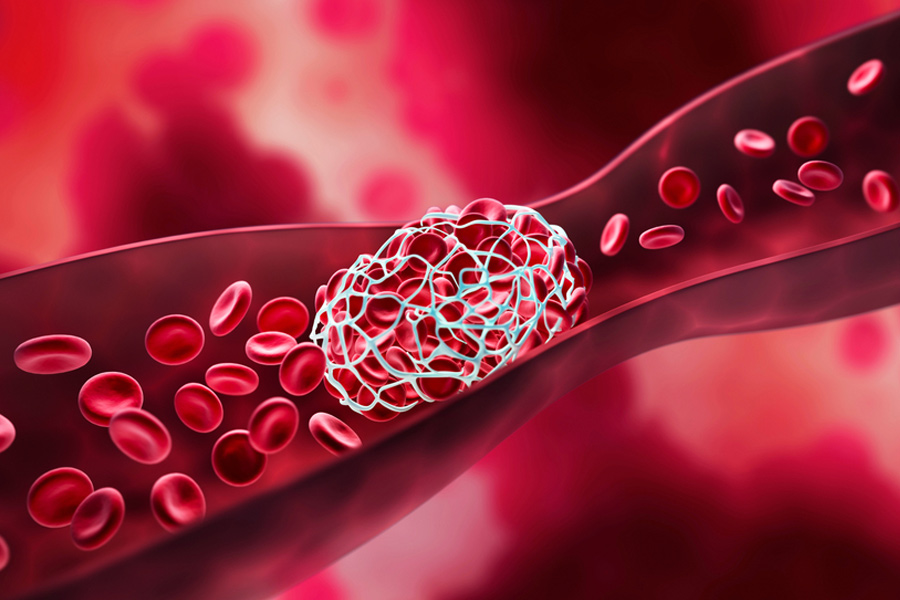 blood-clot-treatment