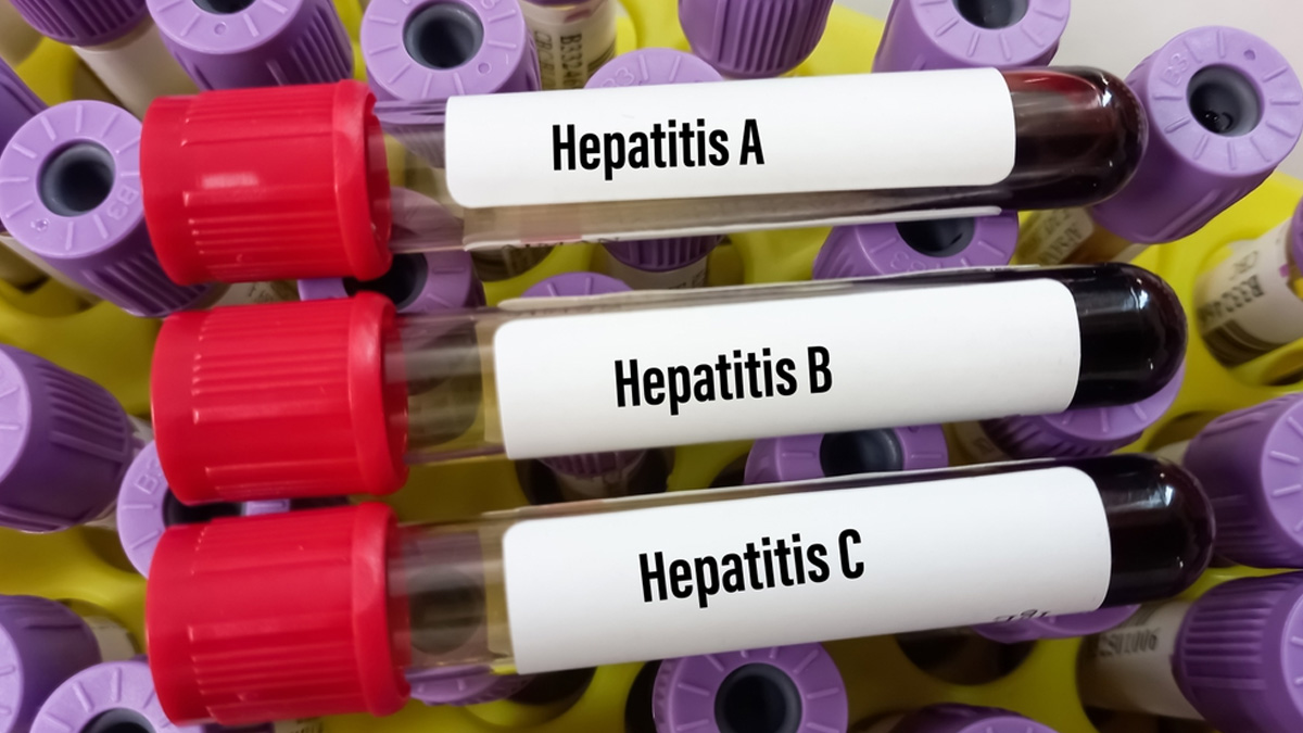 hepatitis