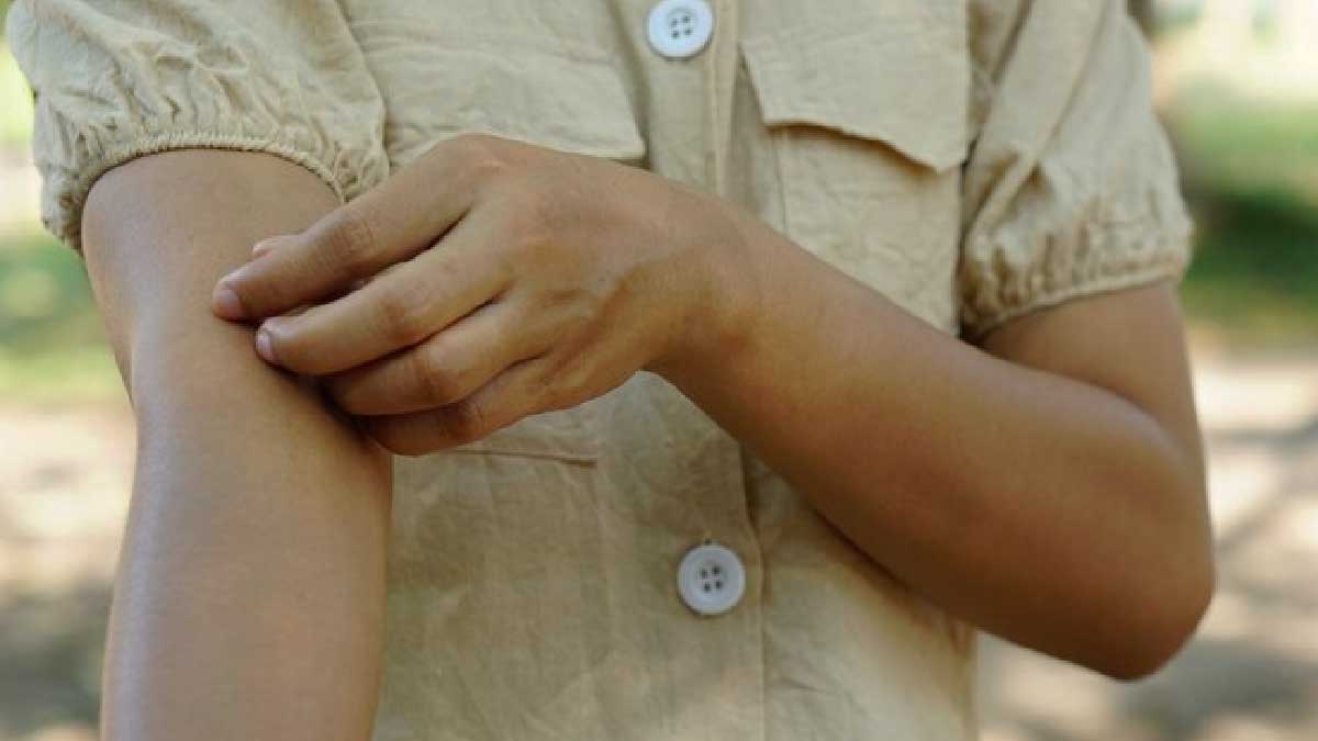 Causes Of Itching In Dengue Fever In Hindi