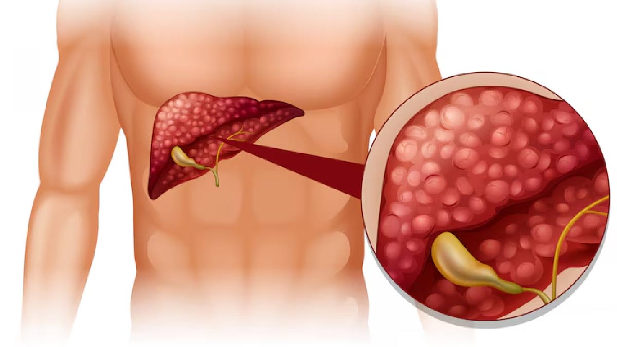 Signs Of Fatty Liver Disease On Feet In Hindi