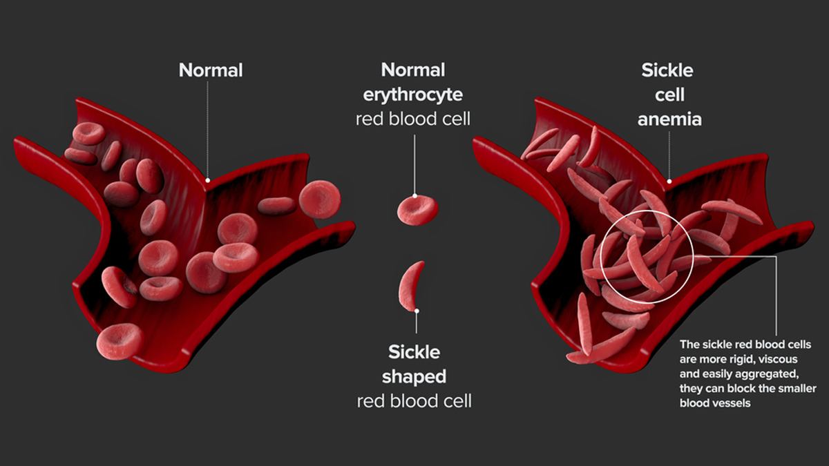 sickle cell