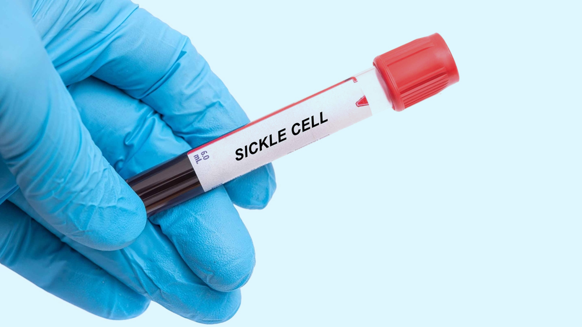 sickle cell
