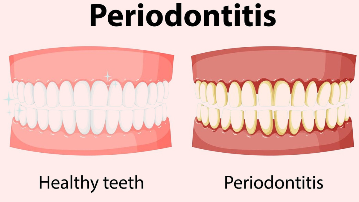 periodontitis