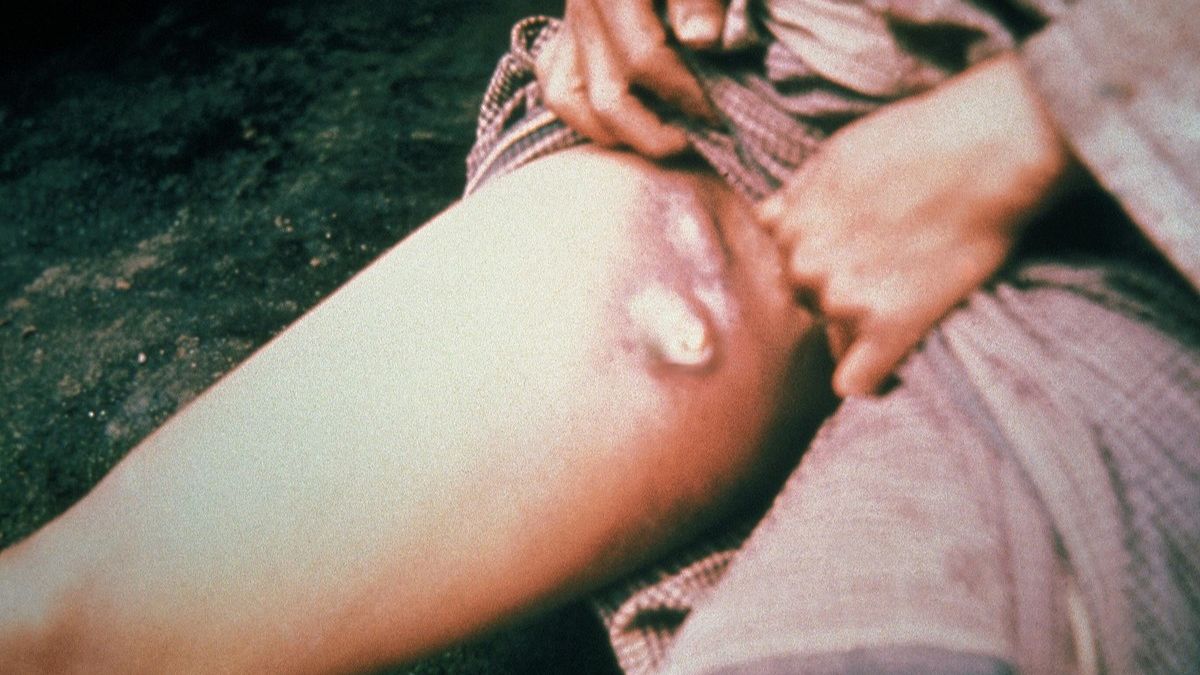 Health Officials Confirm Cases Of Bubonic Plague In US: Symptoms, Causes, Treatment