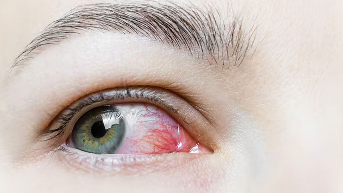 ayurvedic remedies for eye problems in monsoon