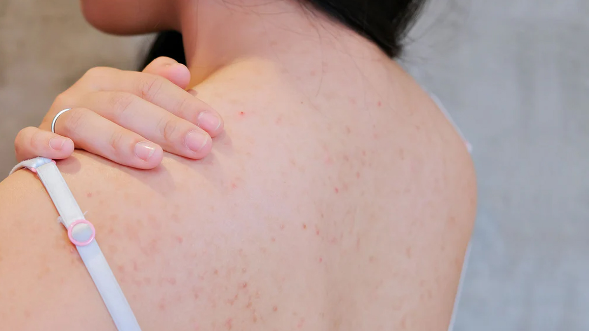 side effects of wearing dirty bra