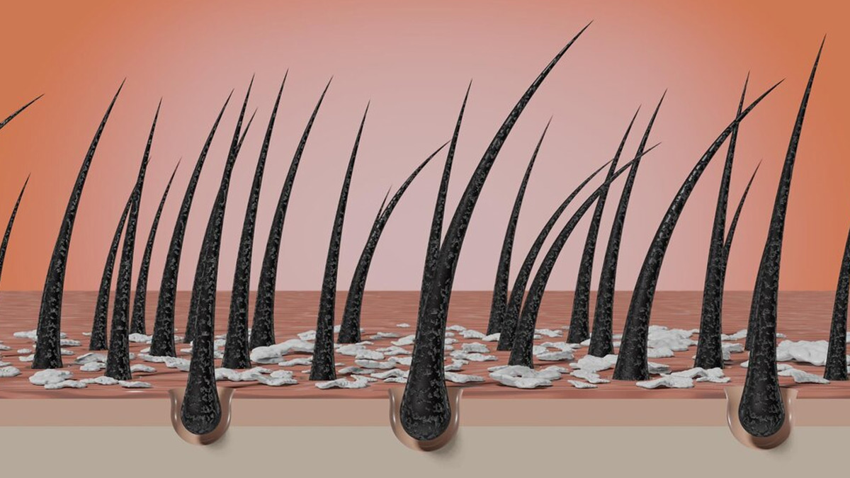 how dandruff affect hair health