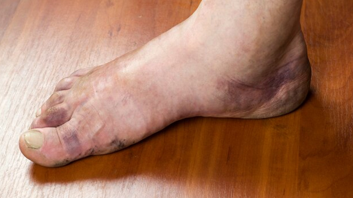 early stage of diabetic foot ucler