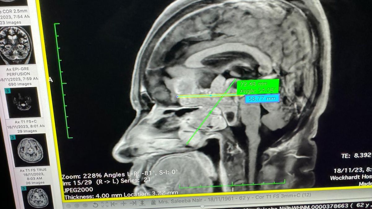 63-Year-Old Gets Miraculous Relief From Rare Largest Tumour On Her Pituitary Glands