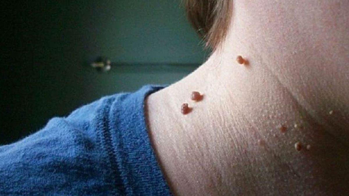 causes of skin tags