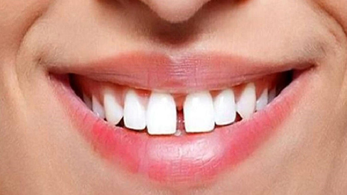 gap between teeth