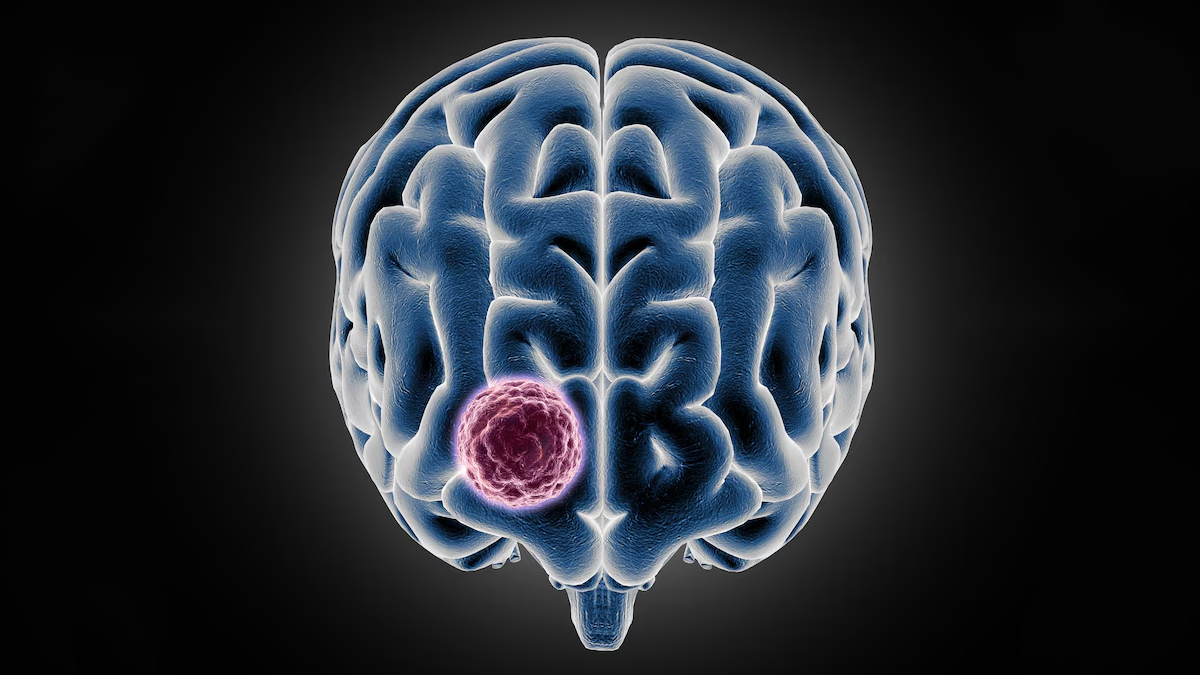 brain tumour