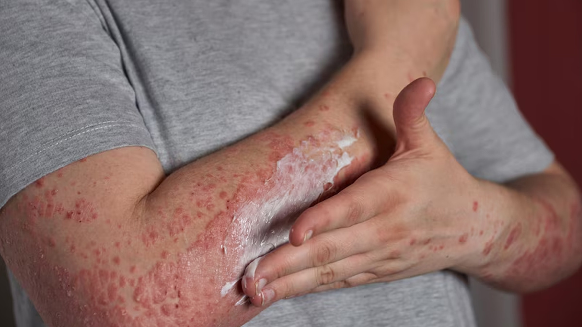 eczema