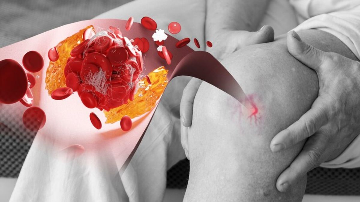 Dealing With High Uric Acid Levels? These Exercises Can Help You