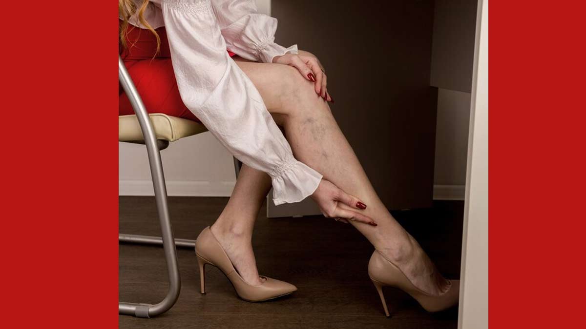 How Does Footwear Affect Varicose Veins In Hindi