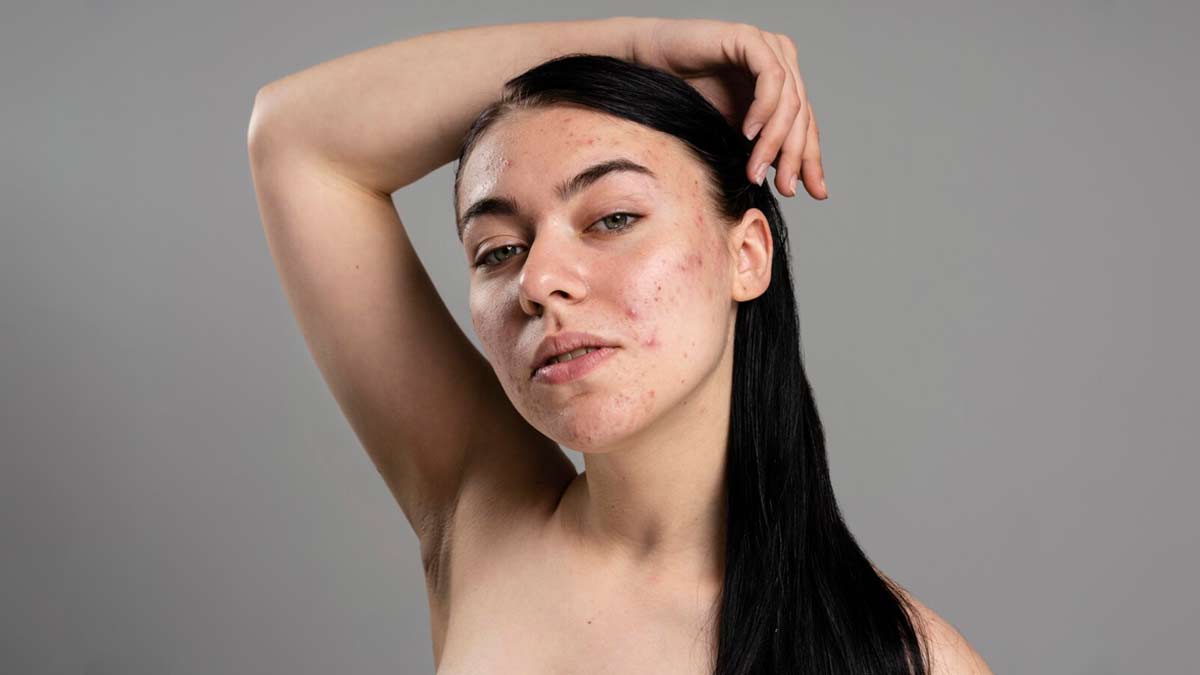 Difference Between Acne And Pimples In Hindi