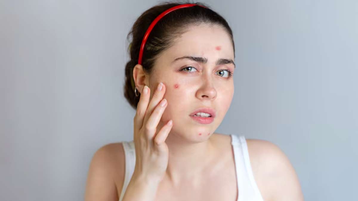 Difference Between Acne And Pimples In Hindi