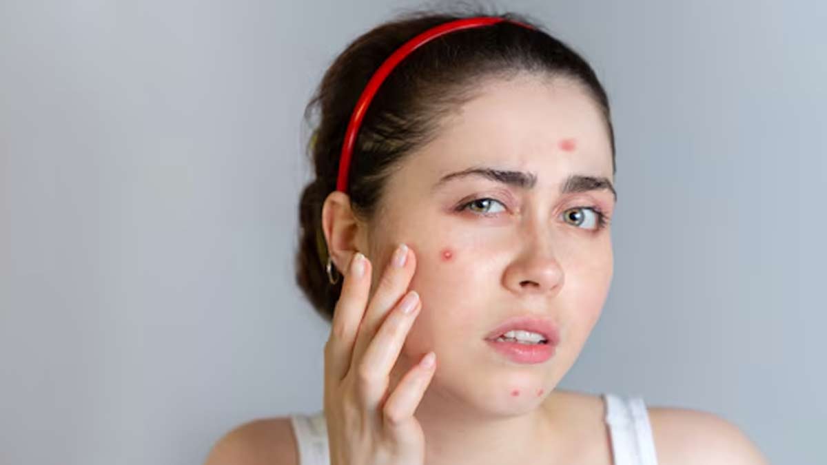 can hair supplements cause acne