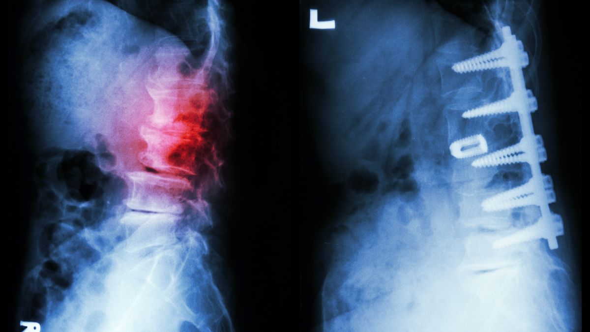 Does Your Child Have Unexplained Back Pain? Expert Warns It Could Be Spondylolisthesis