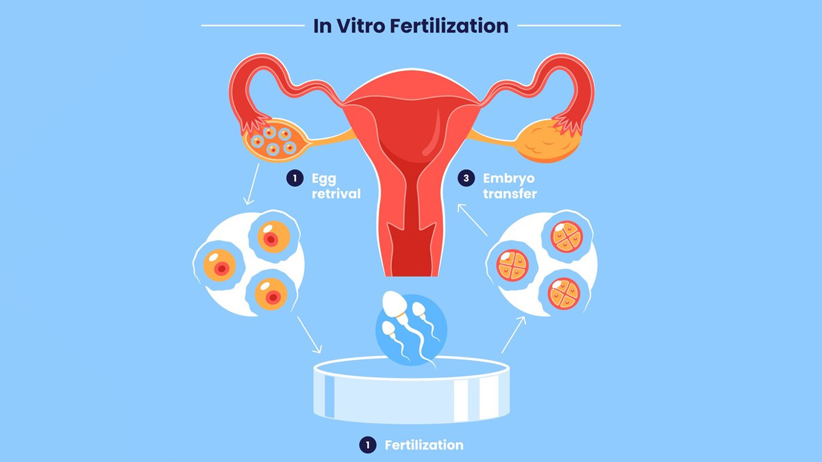IVF