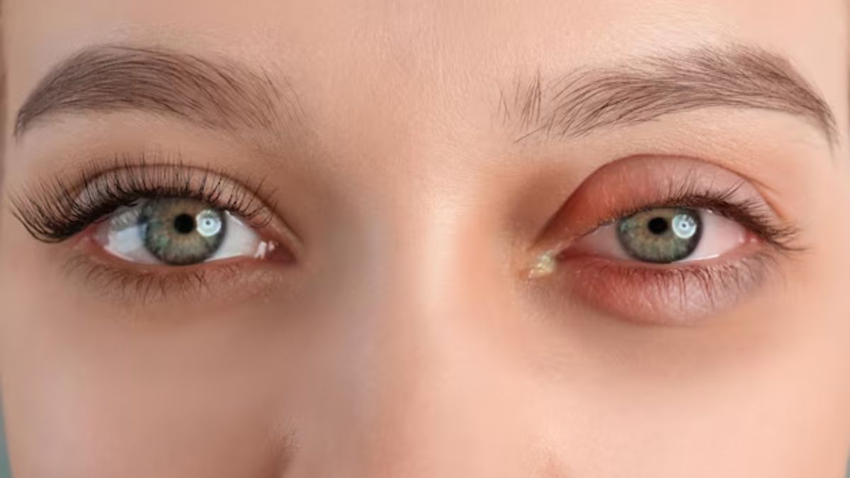 Dietary Habits To Avoid During Conjunctivitis
