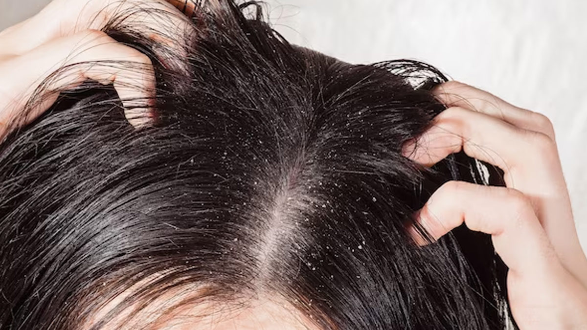 can stress cause dandruff