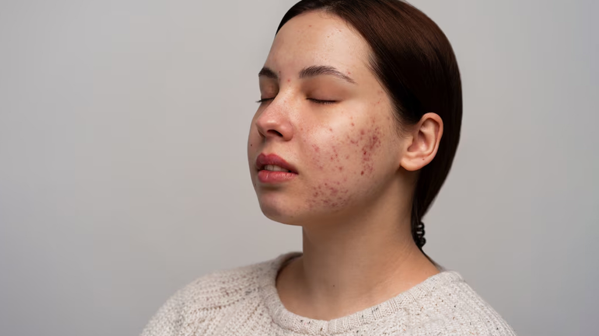 Cancer-Causing Chemical Benzene Found In Leading Acne Products In US, Natural Alternatives To Treat Acne Scars