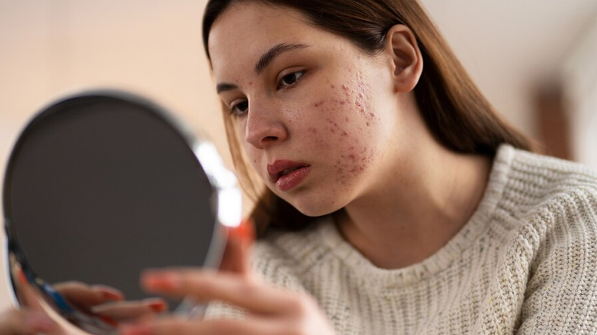 Cancer-Causing Chemical Benzene Found In Leading Acne Products In US, Natural Alternatives To Treat Acne Scars