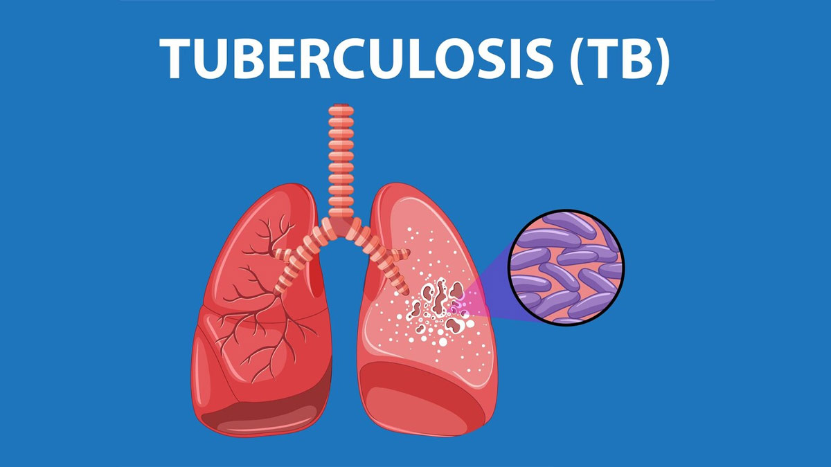 Disadvantages of losing weight in TB patients