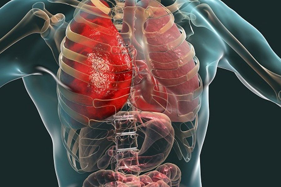 Multiple Organ Failure