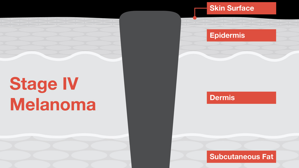 Stage 4 Melanoma