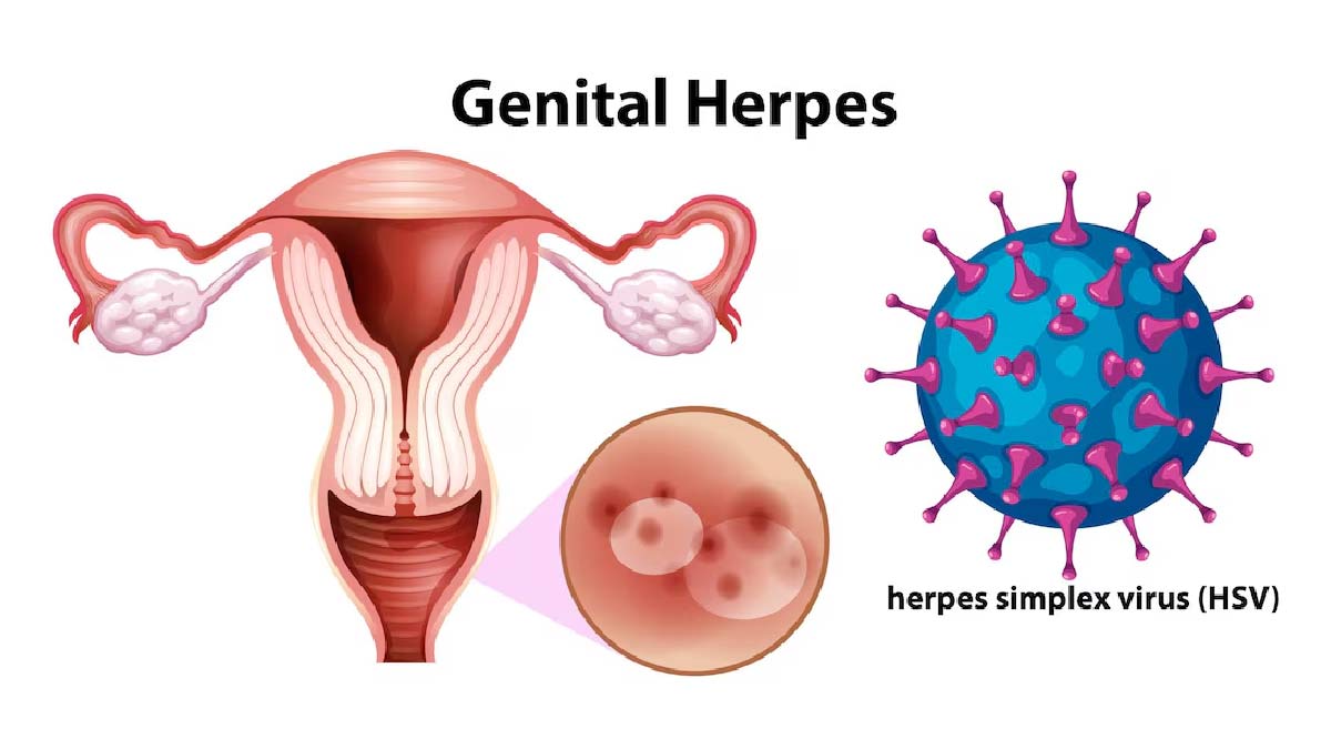 herpes
