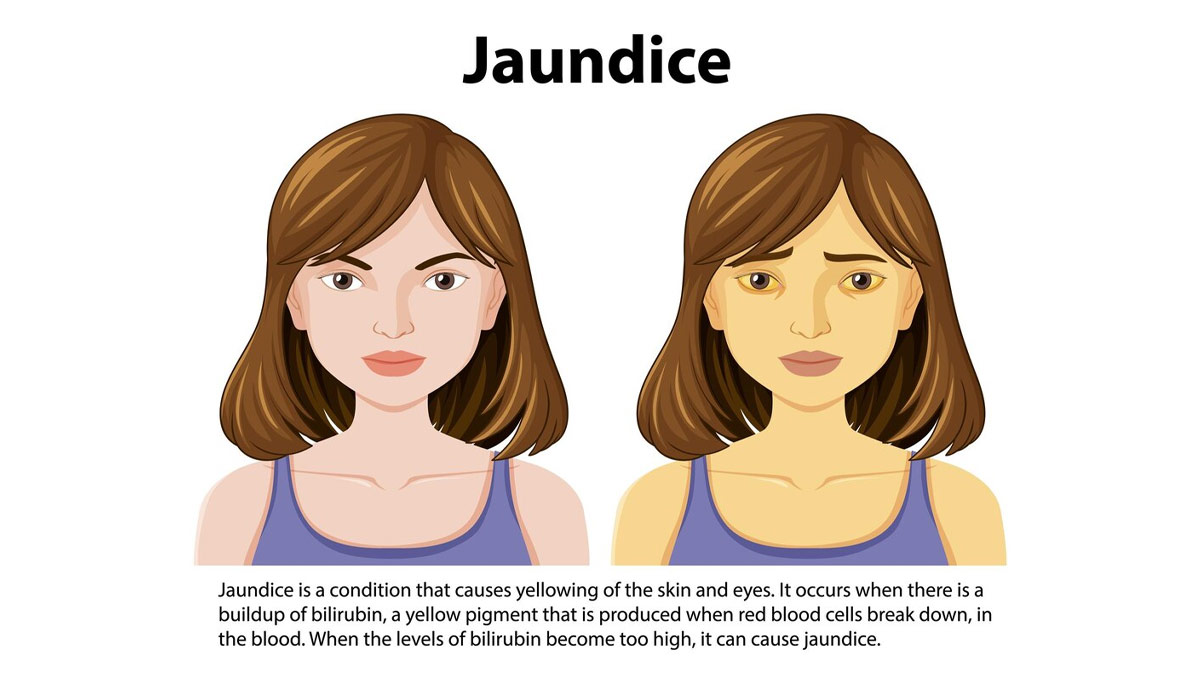 Jaundice