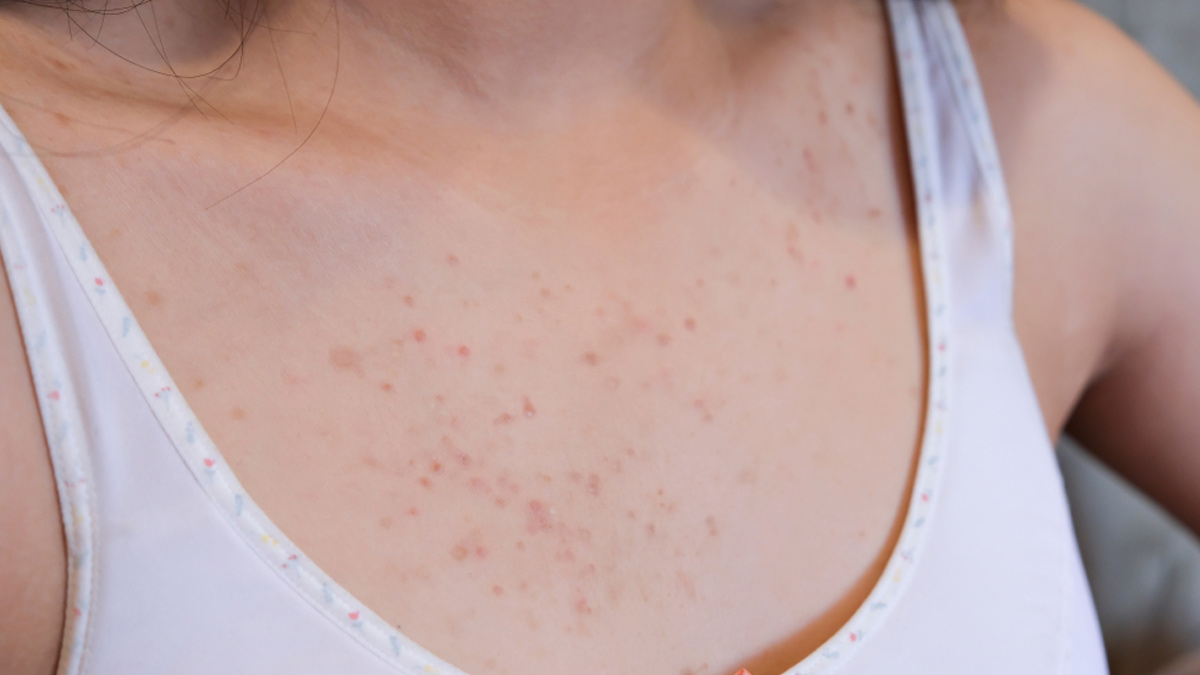 chest-acne