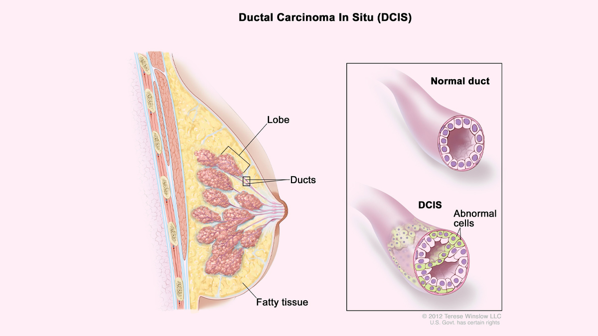 Ductal Carcinoma