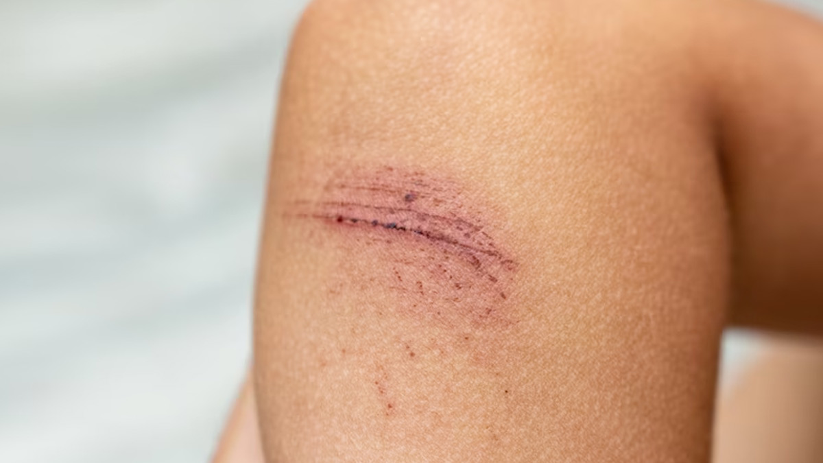 Signs and Symptoms Of Protein Deficiency