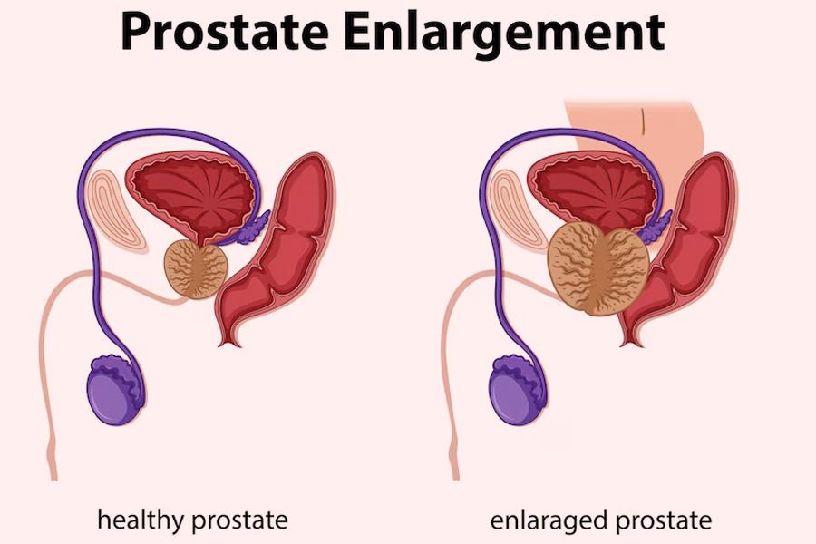 Prostate enlargement