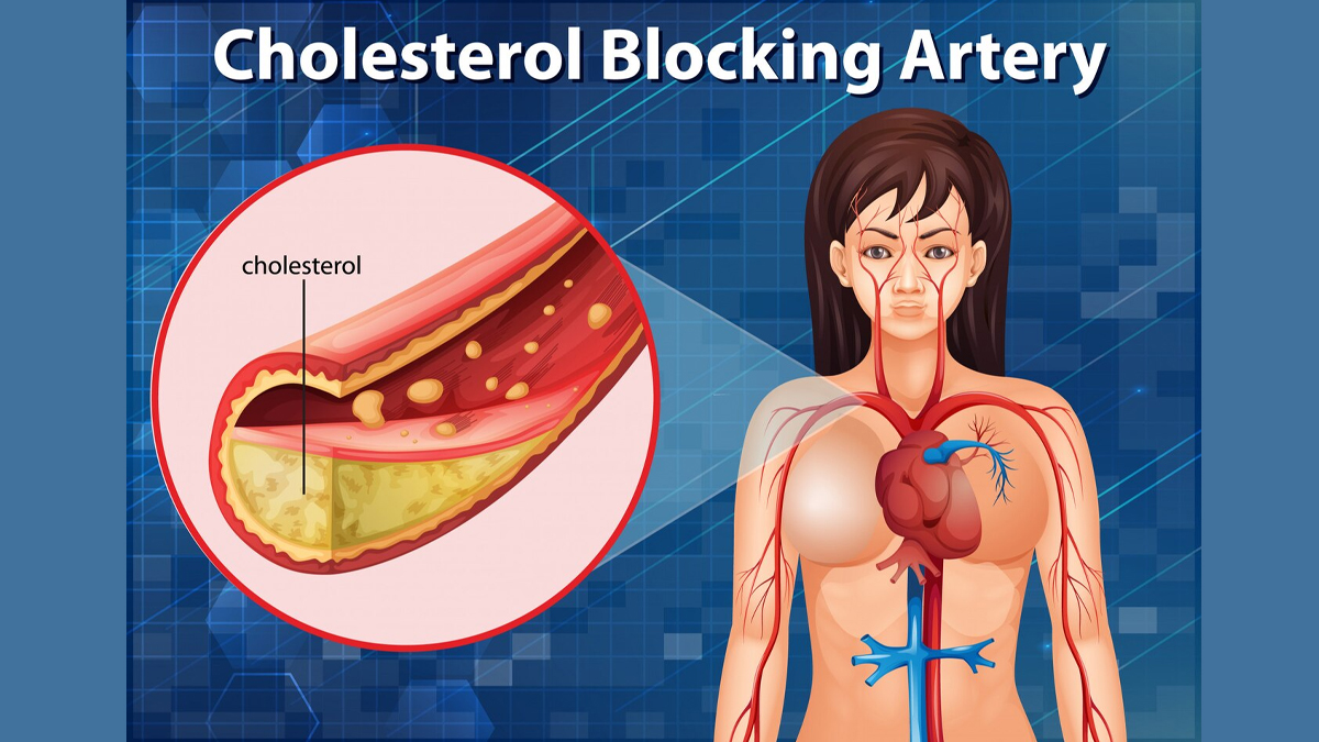 Symptoms Of High Cholesterol In Females In Hindi