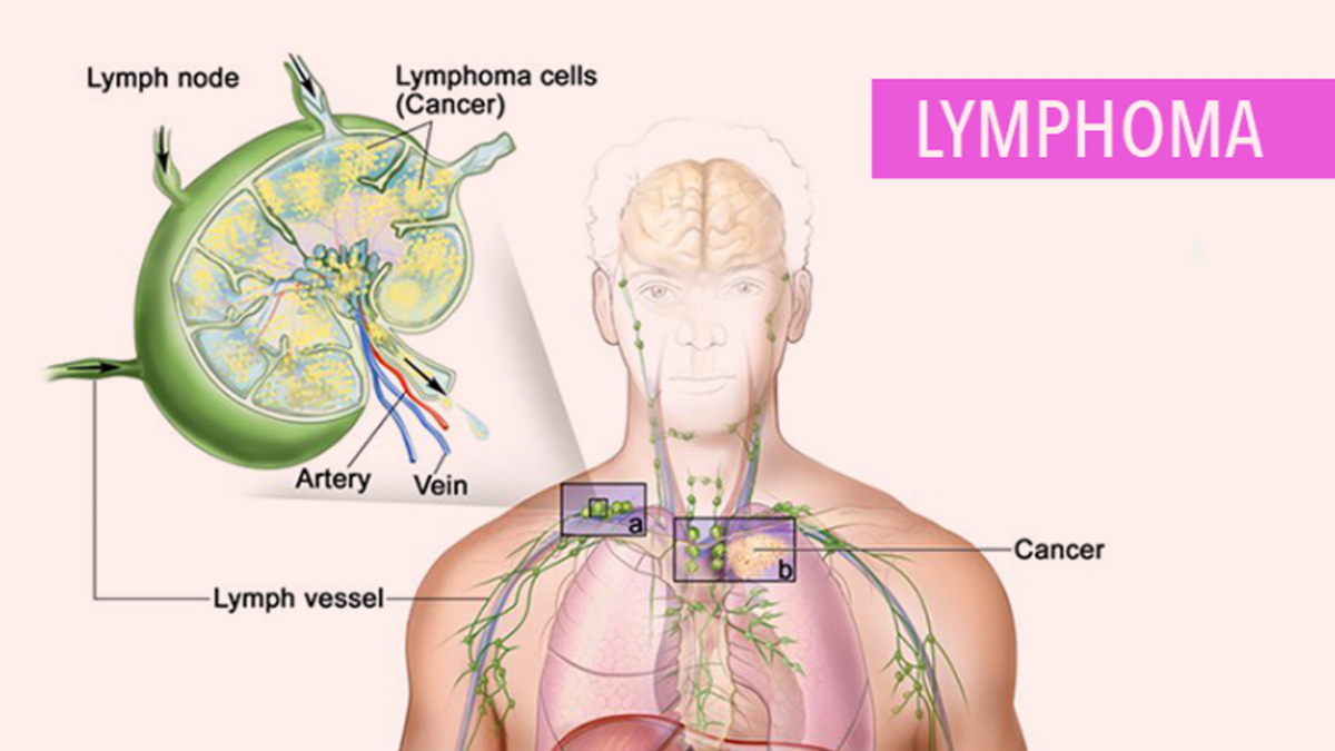 Lymphoma