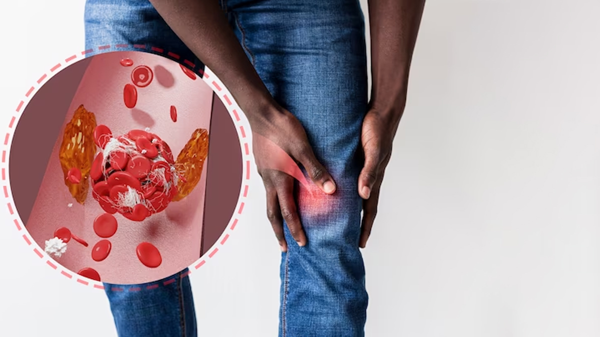Leg Blood Clotting