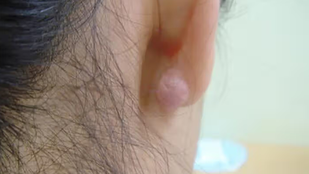 keloids in ear in hindi