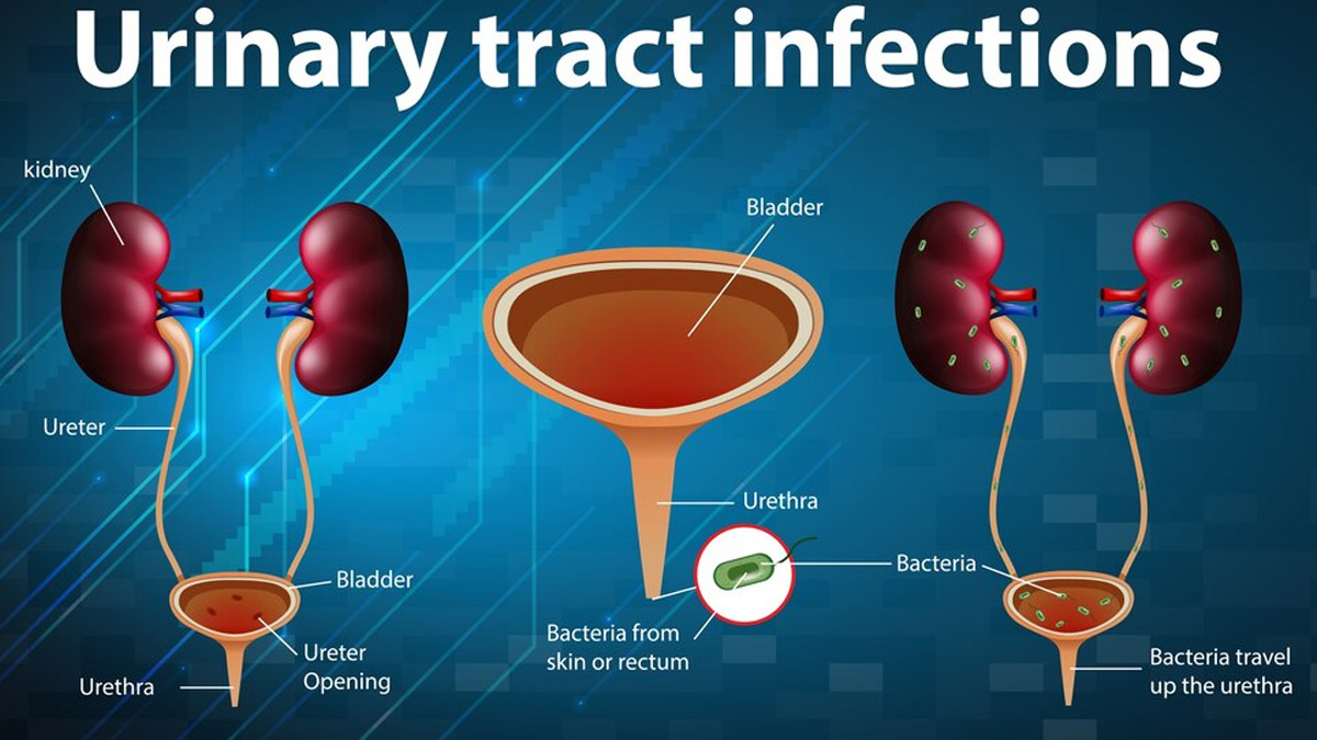 urinary-tract-infection