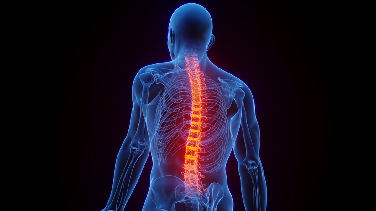 spondylitis