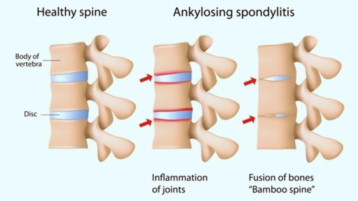 spondylitis