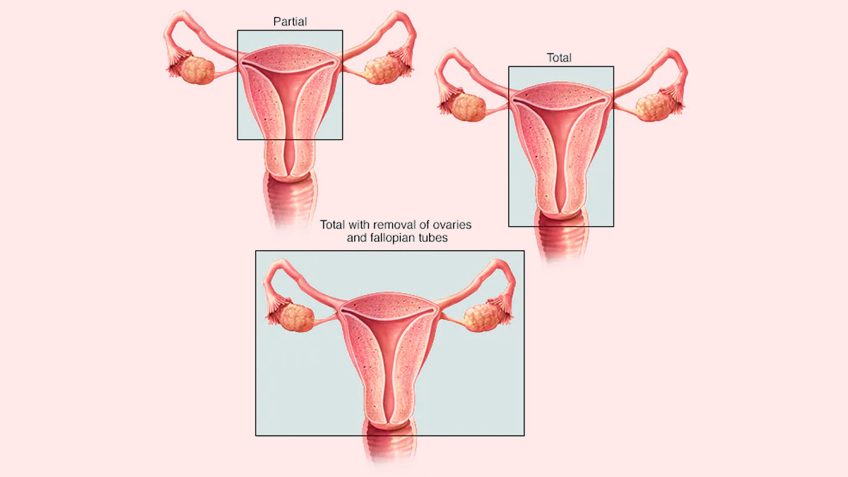 Hysterectomy
