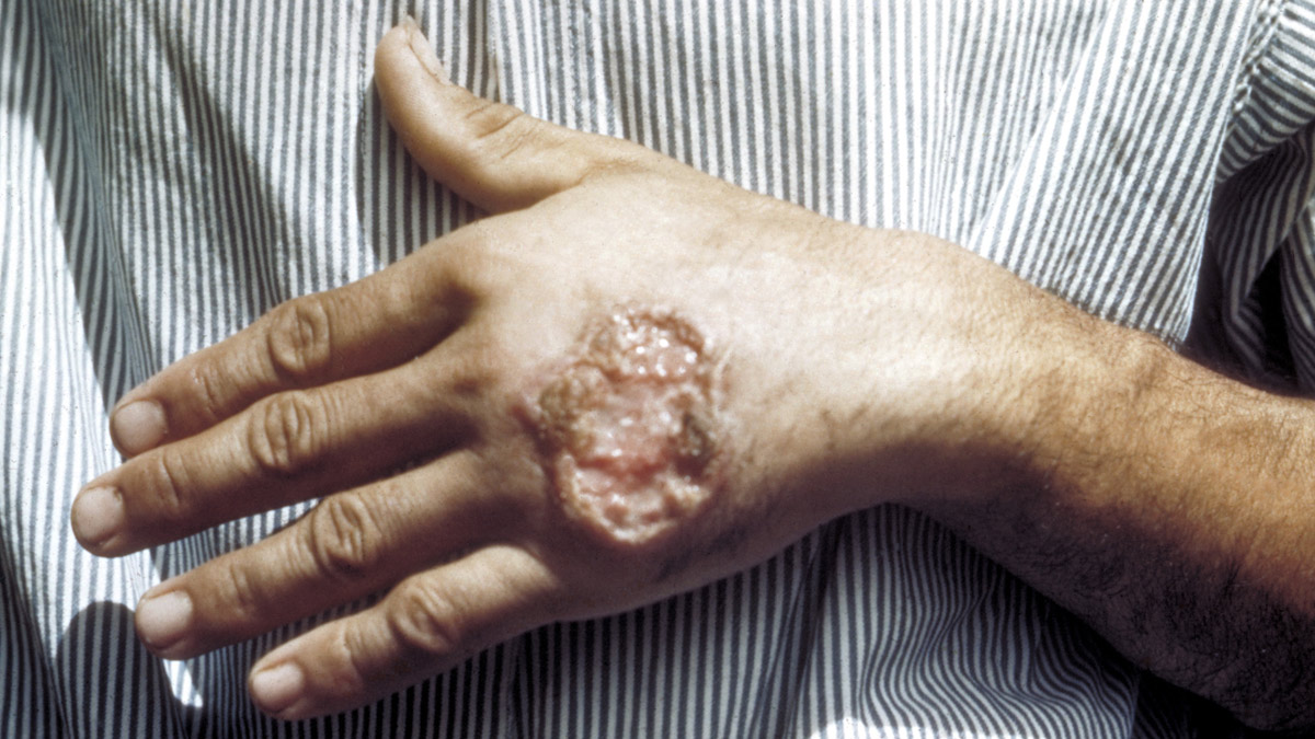 Rising Cases of Leishmaniasis in Jammu & Kashmir: Here’s What You Need To Know About This Parasitic Disease