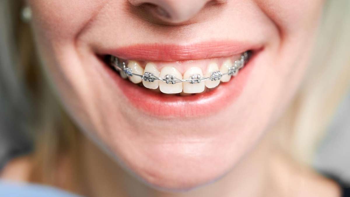 food to eat and avoid with braces in hindi